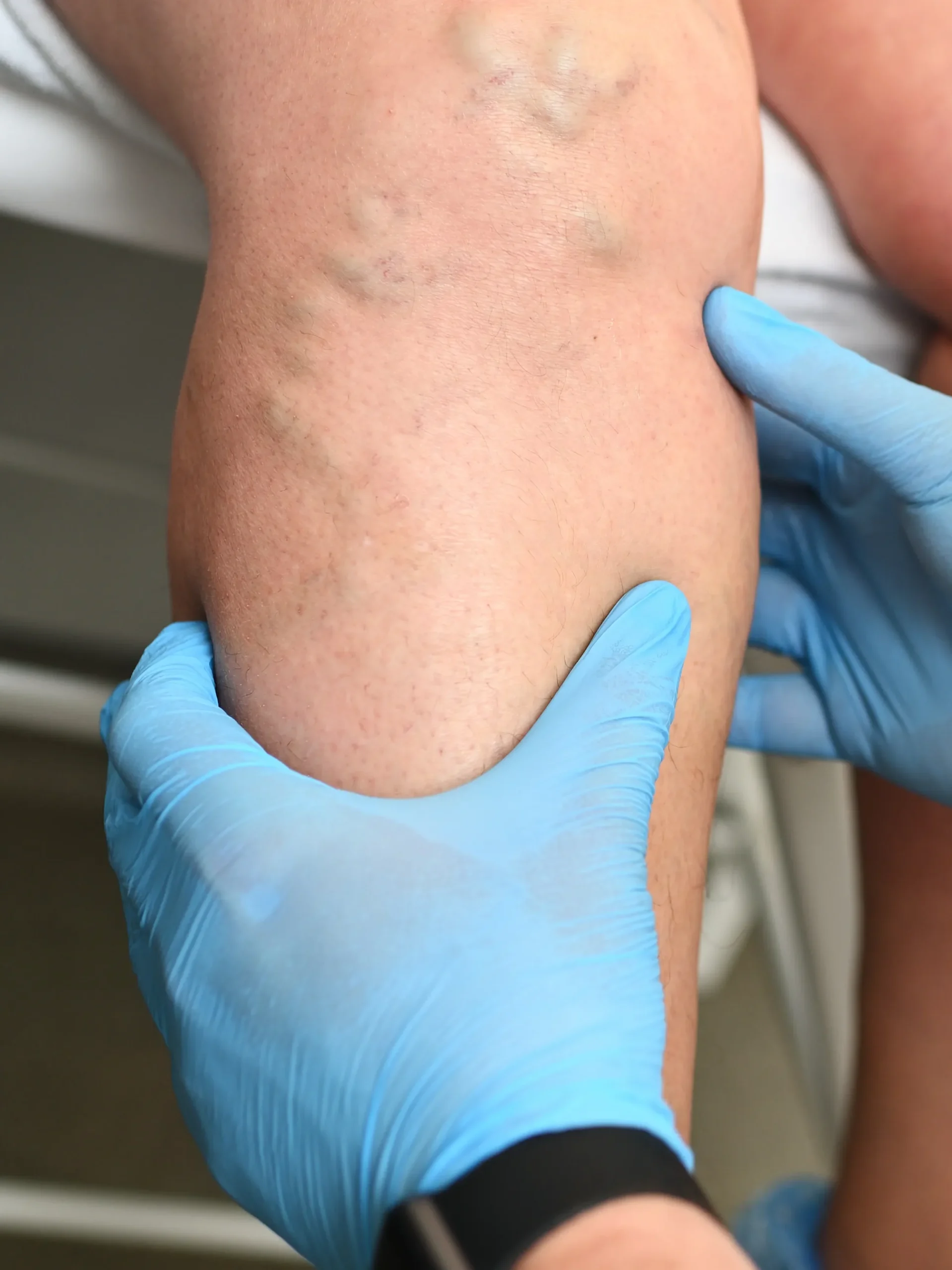 Lymphedema patient leg being assessed by therapist hands with gloves